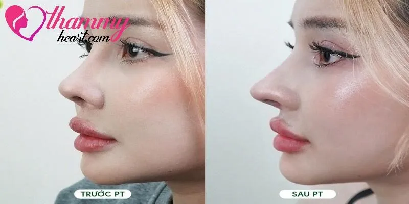 Hình ảnh trước và sau nâng mũi thẩm mỹ