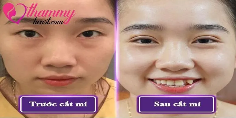Hình ảnh trước và sau cắt mí thẩm mỹ