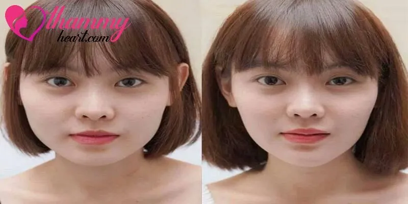 Hình ảnh trước và sau khi tiêm filler thu gọn cằm