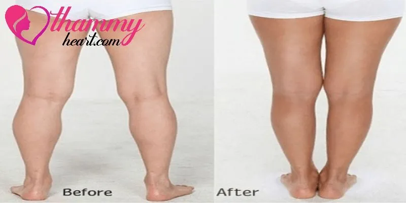 Loại bỏ mỡ thừa ở chân không chỉ cải thiện thẩm mỹ mà còn nâng cao sức khỏe