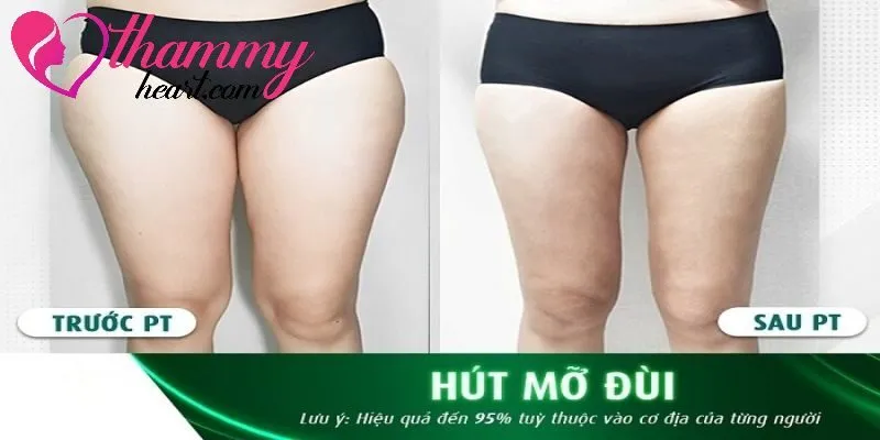 Khách hàng sở hữu đôi chân thon gọn sau khi hút mỡ đùi tại Thẩm Mỹ Heart
